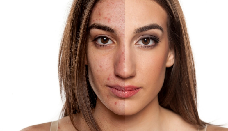 7 visual body signs acne Rick Hay Healthista