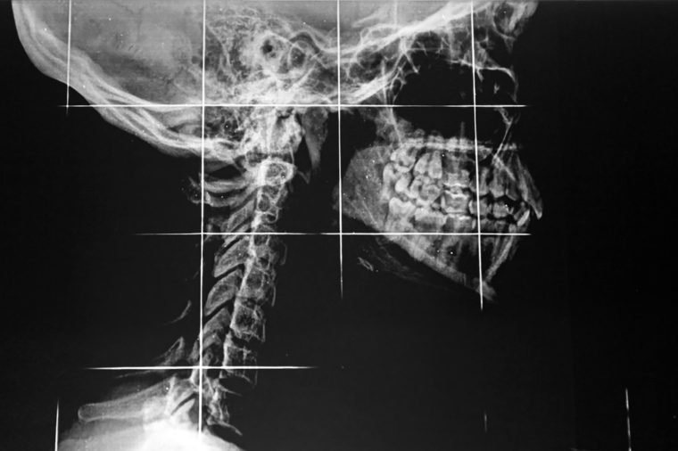 xray