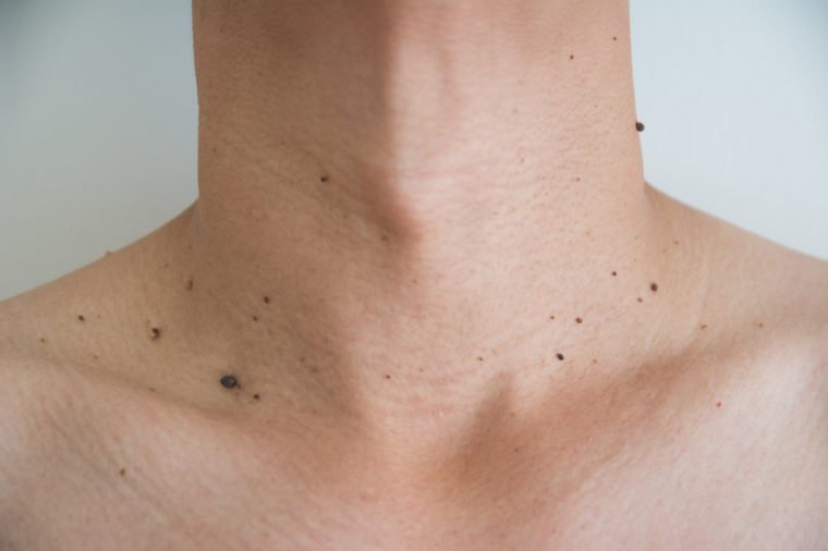 Mole or wart on the men skin