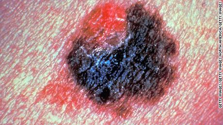 Experimental blood test could detect melanoma skin cancer early, study finds