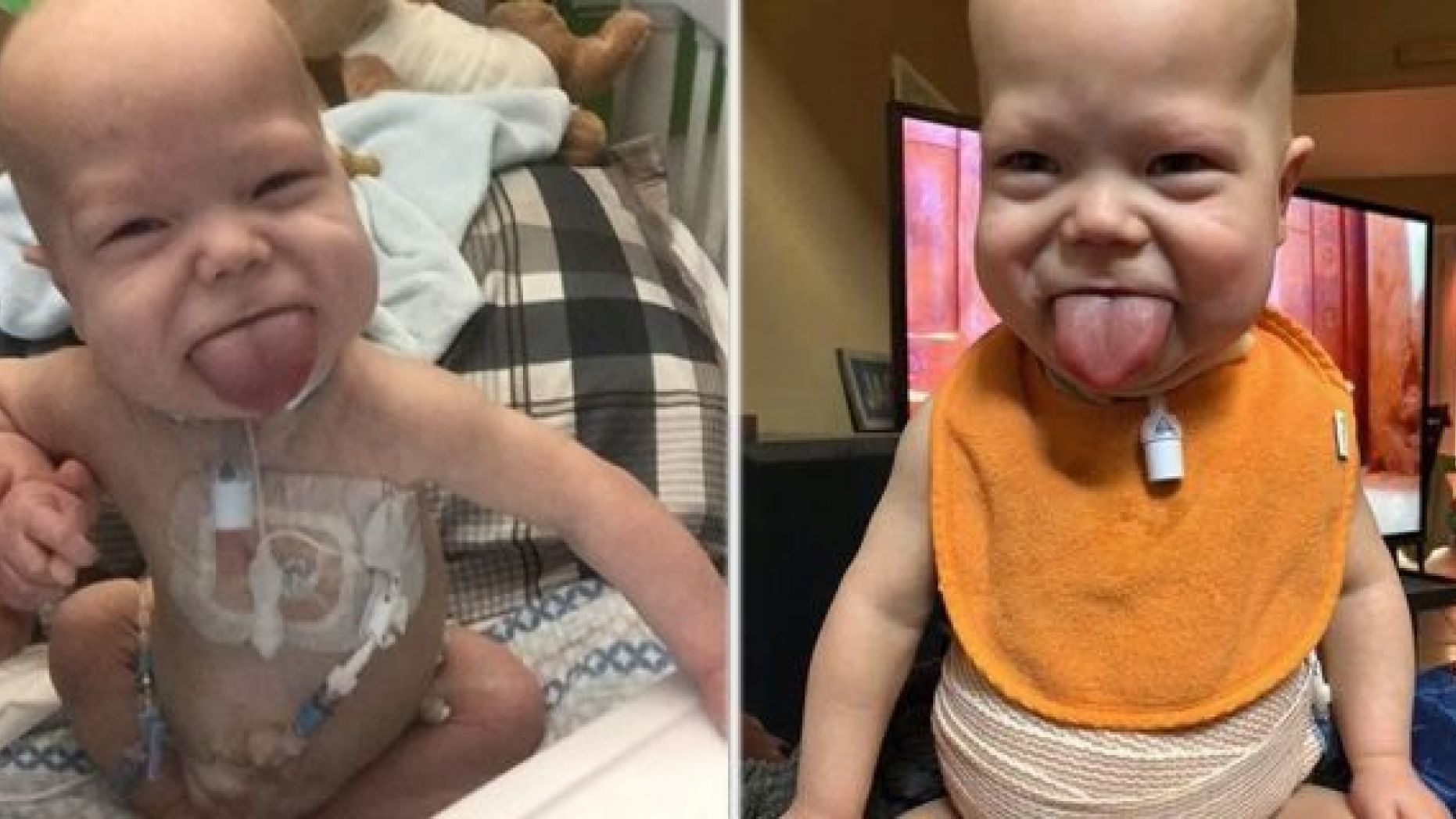 The Oklahoma toddler has a rare condition known as Beckwith-Wiedemann Syndrome, which causes his tongue to be abnormally large. (Caters News Agency)