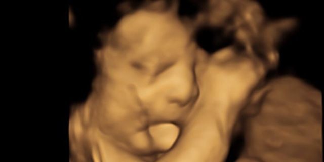 Baker's ultrasound showed the young boy's tongue sticking outside of his mouth, a sign of what his mother didn't realize at the time was BWS. (Caters News Agency)