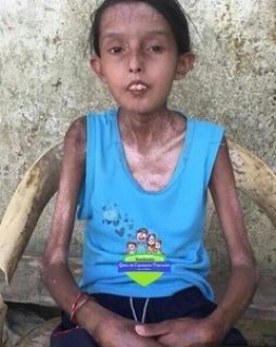 Dailis, age 15 has progressive systemic sclerosis lives in a village three hours outside of Caracas in a single-mother household. She is also suffering from severe malnutrition, is so weak that she cannot walk, and is barely able to talk.