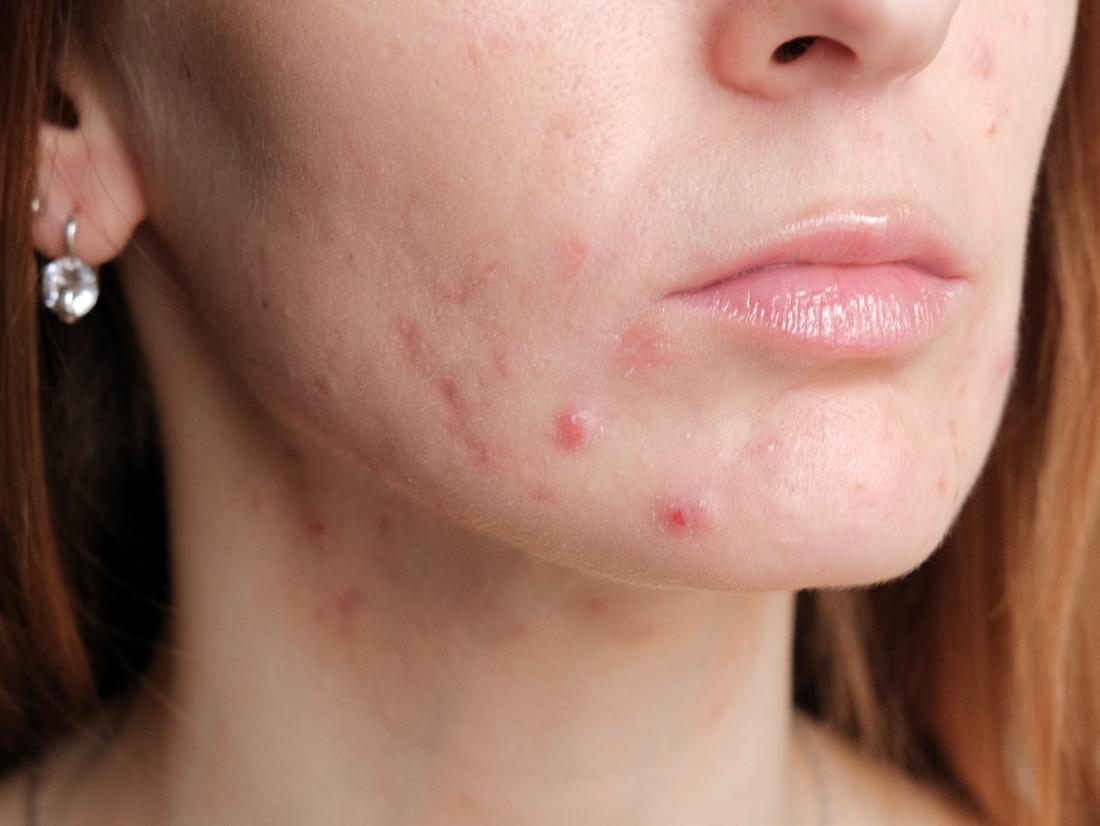 a woman with Pregnancy acne