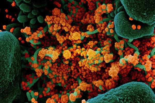 An apoptotic cell heavily infected with coronavirus, orange, isolated from a patient sample.